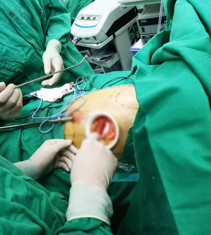 胸腔镜手术